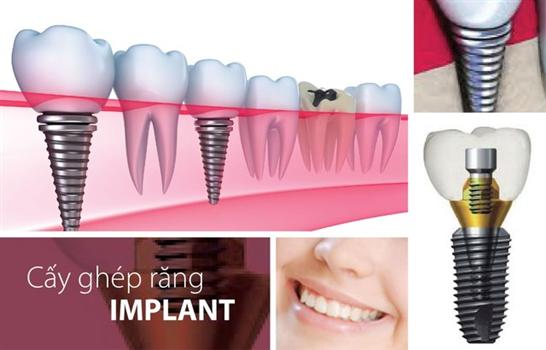 bieu-hien-viem-quanh-implant-o-benh-nhan-cay-ghep-implant