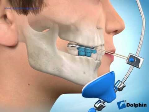 sau khi sử dụng h&agrave;m face mash