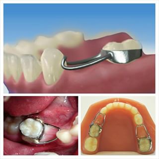 h&agrave;m giữ khoảng một b&ecirc;n
