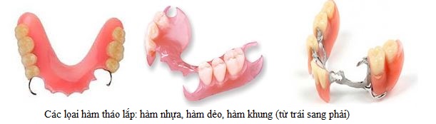 c&aacute;c loại phục h&igrave;nh th&aacute;o lắp