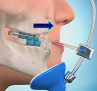 h&agrave;m face mash k&eacute;o h&agrave;m tr&ecirc;n ra trước