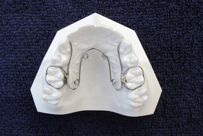h&agrave;m nắn chỉnh nha khoa Quardhelix