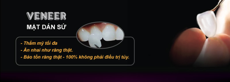 mặt d&aacute;n sứ Veneer