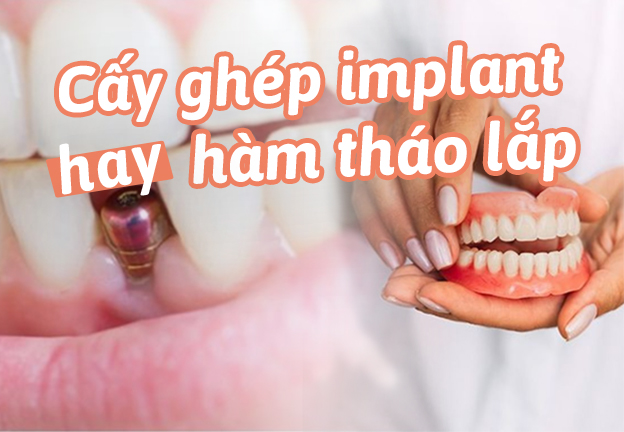 Implant vs răng/hàm giả tháo lắp - Phương pháp nào dành cho bạn?